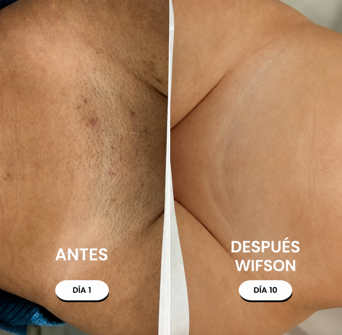 Depiladora 5-en-1 Wifson®