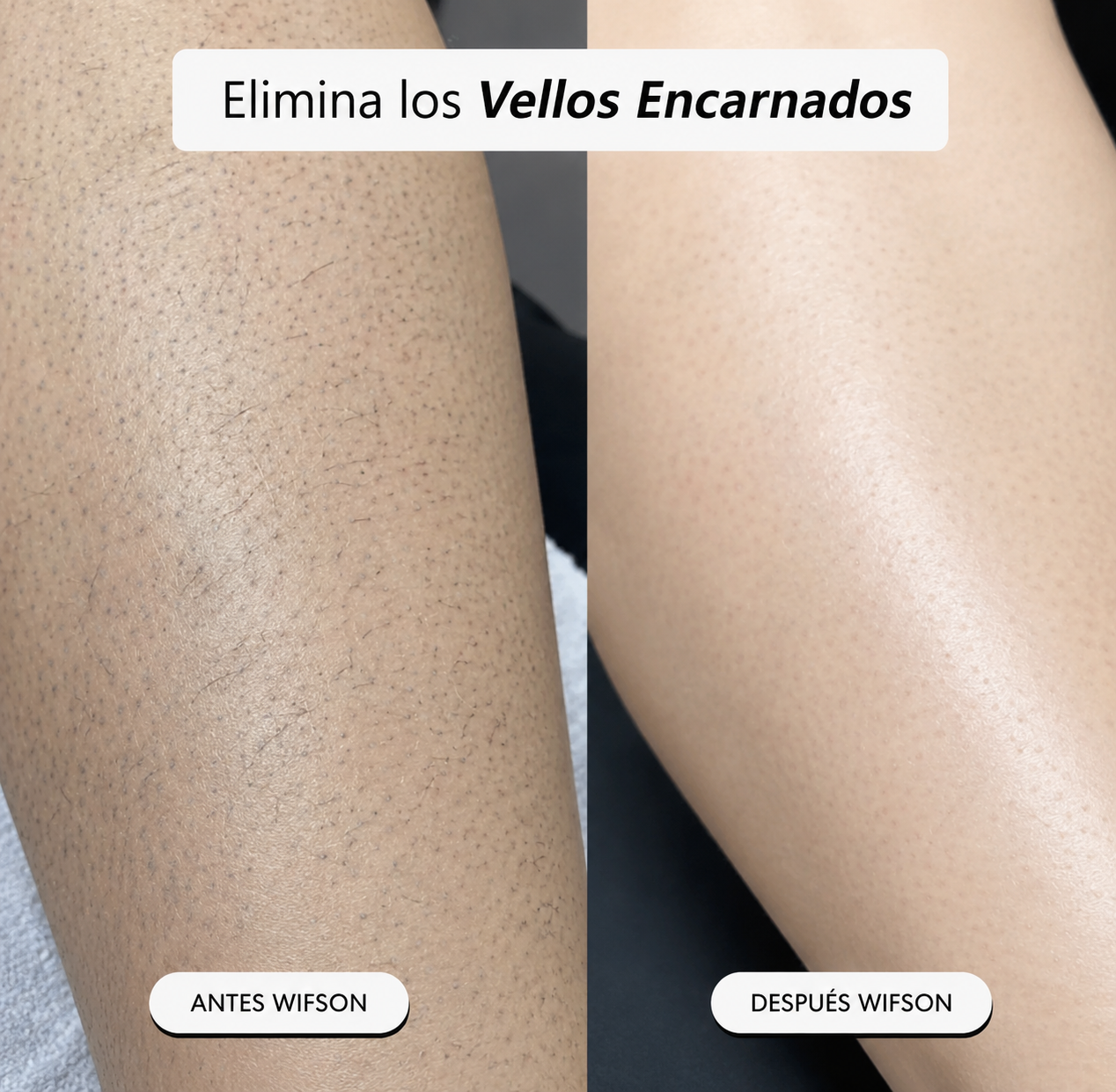 Depiladora 5-en-1 Wifson®